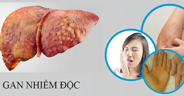 dau-hieu-gan-nhiem-doc 